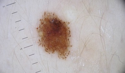 Imaginea dermatoscopica a unei alunite 